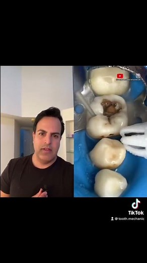 One of the biggest cavities I have seen😱#filling #tooth #dentistry