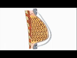 Breast Reconstruction after Mastectomy using BRAVA with Fat Transfer