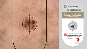 39K views · 74 reactions | New virtual technology is being used to diagnose skin cancers, allowing people in lockdown and remote areas to get life-saving treatment. Australia has the highest rate of melanoma in the world but patients who catch it early have a 95% survival rate. More info: https://7news.link/39KkeY6 #7NEWS | 7NEWS Sydney | Facebook