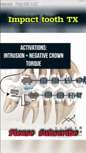 Can Braces Fix an Impacted Tooth? Here's How