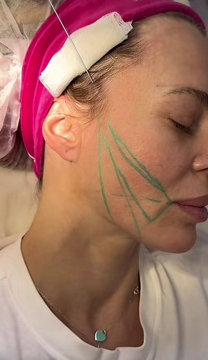 #fyp #viral #explore #botox #اسطنبول #اكسبلور