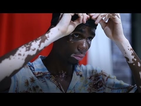 Ce mannequin nous prouve que le vitiligo n'est pas un problème