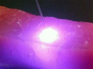 Hemostasis and Coagulation with Ablative Soft-Tissue Dental Lasers and Hot-Tip Devices