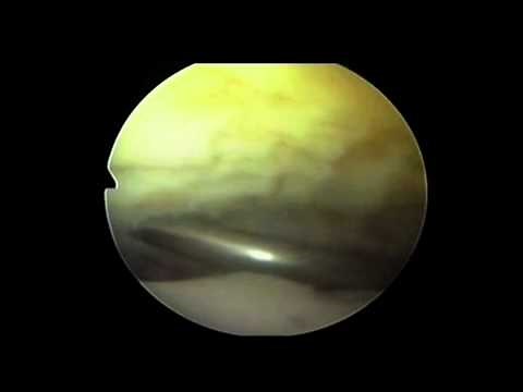 Performing an Arthroscopic Ankle Arthrodesis Surgery | Simon Moyes Capital Orthopaedics