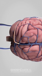 89K views · 670 reactions | Synchron's stentrode™ is a neural interface designed to overcome ##paralysisby creating a digital bypass from the ##brainto an assistive device. Direct brain control of a mouse, a keyboard and even vehicles may become possible ##technologyto restore. #awareness | Mix Dancing Events | Facebook