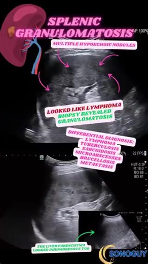 SPLENIC & LIVER GRANULOMATOSIS What It Looks Like on Ultrasound 🔍 • Multiple small, round hypoechoic nodules in the spleen • Patchy, inhomogeneous liver texture • Sometimes mild splenomegaly • No mass effect, usually no vessel displacement 🧬 Differential Diagnosis ⬇️ • Sarcoidosis — classic, often with ↑ sIL-2R • Brucellosis • Tuberculosis • Fungal infections (histoplasmosis, candidiasis) • Lymphoma (always keep in mind in nodular spleen!) • Crohn’s-associated granulomas (rare but possible) | 