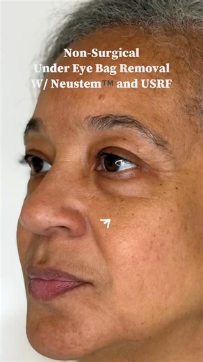 Dr. Simon Ourian | Cosmetic Dermatology Beverly Hills on Instagram: "The Neustem under-eye bag removal smooths puffiness, reduces under-eye swelling, and restores a more rested, youthful appearance. By addressing fluid retention, fat prominence, and skin laxity, this Epione-exclusive treatment answers common concerns like why under-eye bags appear, how to reduce eye bags, and what really works for puffy eyes. 👇 Comment “undereyes” for treatment details and consultation options. #UnderEyeBags #E