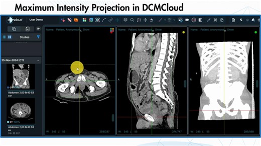🔬 Radiology isn’t just about images — it’s about insights. With DCMCloud’s DICOM Viewer, radiologists can go beyond the basics. One powerful feature is MIP (Maximum Intensity Projection) — a technique that highlights the densest structures in scans, like vessels and bones, with unmatched clarity. 👉 In this video, we show how MIP works seamlessly inside DCMCloud: Sharper visualization of key anatomy Faster decision-making for clinicians Cloud-based access anytime, anywhere 💡 Why does this matt