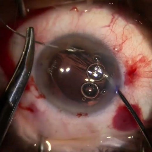 Traumatic crystalline lens dislocation and mydriasis repair