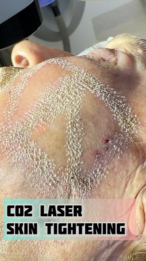 Dr Davin Lim & Dr Park on Instagram: "Nothing tightens like a CO2 laser🔥 . Epic treatment. Epic downtime. Epic results 💯 . 😎Dr Davin Lim Dermatologist 🇦🇺 . #co2laser #ultrapulse #skinrejuvenationprogram"