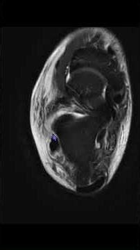 MRI Ankle: Retinacula Overview #msk#antomy#radiology#ankle#trauma#fall#injury#sports#athletes