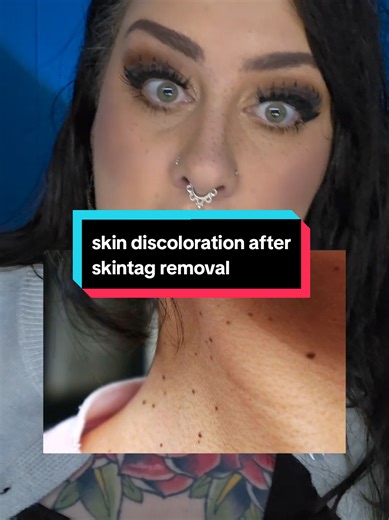 Effective Skin Tag Removal Techniques Revealed
