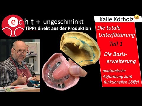Unterfütterung/Basiserweiterung -1. Teil - mit Teleskop-Prothese