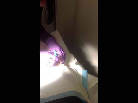 Giant painful boil extraction