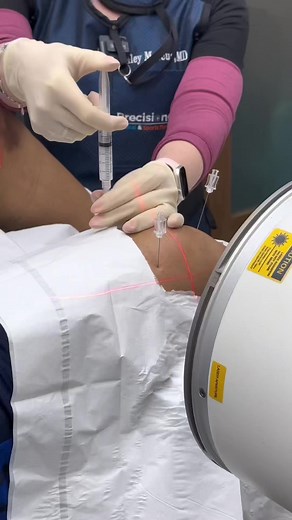 🎥 Watch this video as Dr. Marcus performs a groundbreaking medical procedure known as the Genicular Nerve Block! 😲 🤔 So, what exactly is a Genicular Nerve Block? It's a minimally invasive procedure that targets the genicular nerves in your knee. These nerves are responsible for transmitting pain signals to your brain. By using advanced techniques, our skilled medical professionals can temporarily block these nerves, providing immense pain relief and improved quality of life. 💪 🏃 Who can ben