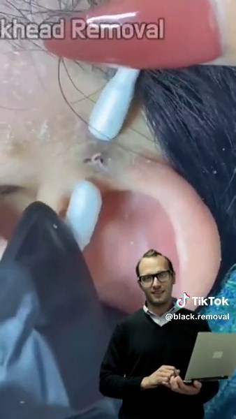 TikTok의 Black Removal