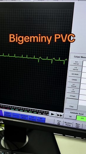 PVC คืออะไร? รู้จัก Premature Ventricular Complex