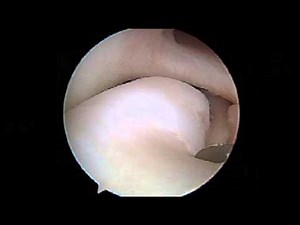 Discoid Meniscus • Video • MEDtube.net