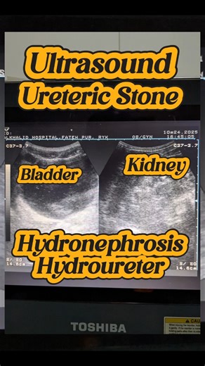 How to scan Renal and Ureteric Stones with Hydronephrosis and Hydroureter | Kidney Stones
