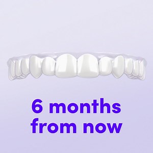 914 reactions · 83 shares | We straighten teeth in an average of 6 months, with clear aligners delivered to your door. Get started today! | Smile Direct Club | Facebook