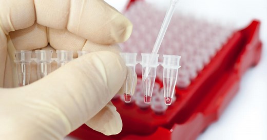 The Cologuard tests stool samples for abnormal DNA. The test was 92-percent effective at catching cancer, and 42-percent effective at finding pre-cancerous polyps
