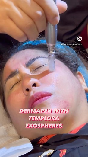 3 comments | Bye Bye Acne Scars! Dermapen microneedling facial...