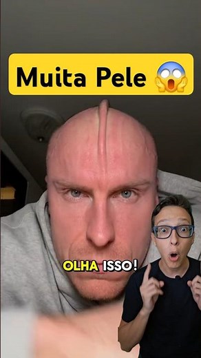 Excesso de Pele na Cabeça 😱 #medicina #medico #enfermagem #enfermeiro #enfermeira #curiosidades