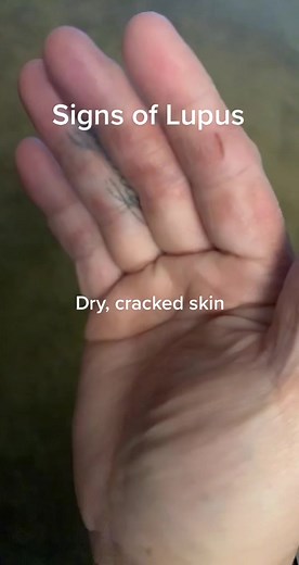 Understanding Lupus: Signs, Symptoms, and Awareness