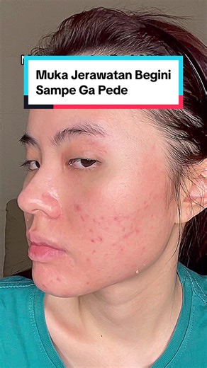 Acne Serum G2G: Rahasia Hilangkan Jerawat dalam Satu Minggu!