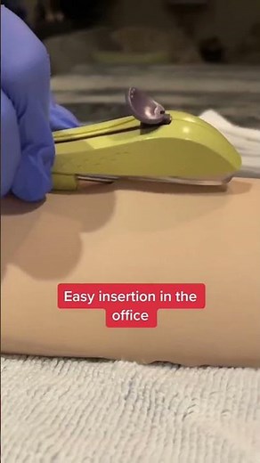Nexplanon is a subdermal birth control implant that is used to prevent pregnancy and help control