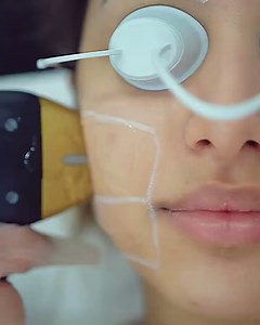 2M views · 5.4K reactions | Super speedy laser hair removal with superior comfortability, even on the face? Sign us up! See #AlmaSopranoTitanium’s working its magic in this video from @ilknuraltintas.be’s practice in Belgium!﻿﻿﻿ #almalasers #laserhairremoval #hairremoval #medicallasers #aestheticlaser #aesthetics #lunchtimeprocedure #dermatology #beauticians #skindoctors #beautydevices #beautyclinics | Alma Lasers International | Facebook