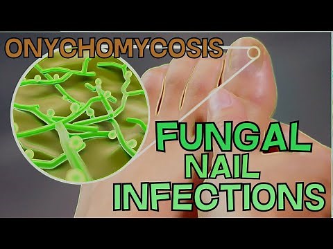ONYCHOMYCOSIS - FUNGAL NAIL INFECTION - DEFINITION, SYMPTOMS, TREATMENT - EXPLAINED in 5 Minutes!!