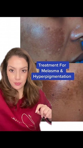 Effective Treatment for Melasma & Hyperpigmentation: Cure with 2/3 Creams