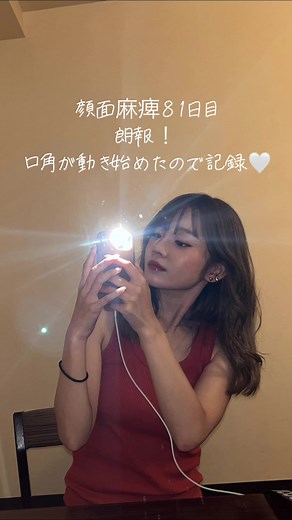 ついに！ 口角の感覚が戻ってきた🫶 #顔面神経麻痺 #左顔面麻痺 #帯状疱疹 #ハント症候群 #記録 #治療中