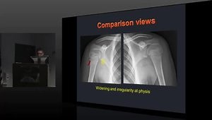 Avulsive and Overuse Injuries in Developing Skeleton