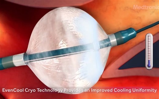 冷冻消融（cryoablation）经皮冷冻球囊消融术（balloon cryoablation）