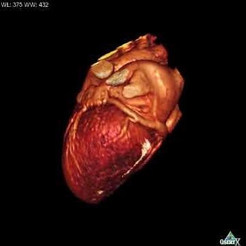 Heart & Scar imaging (part 2)