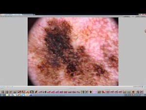 2013 12 09 06 38 Junctional dysplastic Lentiginous nevus