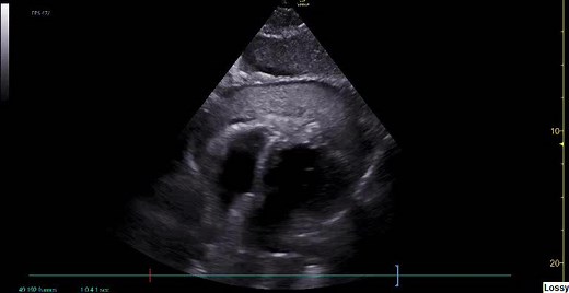 Blow-out left ventricular free wall rupture after myocardial infarction https://academic.oup.com/ehjcr/article/6/5/ytac167/6574591 #EHJCaseReports | European Society of Cardiology