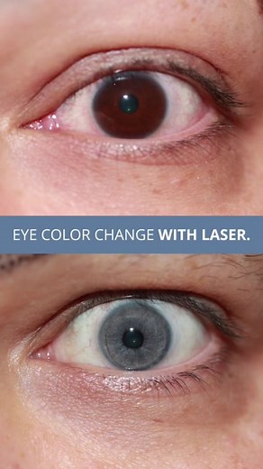 Transforming Eye Color with Laser: From Brown to Yeux Clair
