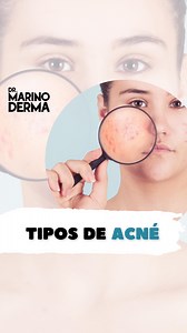 ¿CÓMO SABER QUE TIPO DE ACNÉ TENGO? ⚠️Recuerda que es importante consultar primero con tu dermatólogo, para que te dé un correcto diagnóstico. 📲Agenda por WhatsApp 55 4893 2611⁣ 📲 WhatsApp de farmacia: 55 4001 5724⁣⁣⁣⁣⁣ 📍Calle Liverpool 89-piso 2, Col. Juárez. Alcaldía Cuauhtémoc, Ciudad de México.⁣⁣⁣ 🌐 www.sopranoskin.com 💬 ¿Tienes dudas? Escríbenos. #dermatologia #dermatologist #acne #tiposdeacne #papulas #pustulas #comedones | Dr Marino Dermatólogo