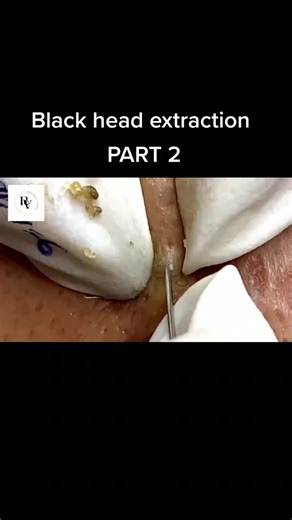 #pimplepoppers #fyp #pimplepopping #pimplepoppingprofessional #tiktok #pimplepopper #pimplepopping_addiction #pimplepop #EverybodyLovesFootball #pimplepopping