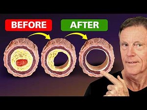 How to Reverse Plaque — 20 Years of Knowledge in One Video