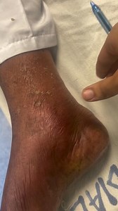 Pitting edema is a type of swelling in which persistent indentation occure on pressure application . Mechanism is fluid accumulation occure in tissue interstitial space. Causes is CHF, cirrhosis, CKD , venous insufficiency and some drugs like CCB and nsaid. | Abroad Medico