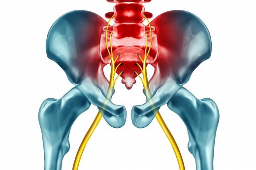 Sciatica Physiotherapy: Treatments & Exercises to Reduce Pain - Thrive Physio Plus