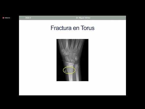 Fractura en tallo verde y prono doloroso