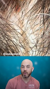 23K views · 82 reactions | Picking at some greasy scabs on the scalp (credit: @scabbyskabs on TT) #scalp #satisfying | Dr. Dustin Portela, Dermatologist | Facebook