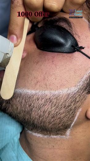 Ramadan Special on Candle Laser Hair Removal