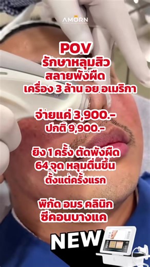 ☄️เปลี่ยนหน้าหลุมเป็นหน้าเรียบ เปรียบเทียบได้ภายในครั้งแรกที่ทำ ☄️ นวัตกรรม Sublative จากเครื่อง E-Matrix ปล่อยพลังงานผ่านหัวทิปทองคำบริสุทธิ์ ☄️ เพียง 1 ครั้ง เห็นผลเทียบเท่าการรักษาหลุมสิวแบบเดิมๆหรือเลเซอร์อื่นๆ