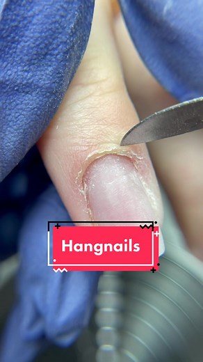 How to Safely Get Rid of Hangnails: Tips and Techniques